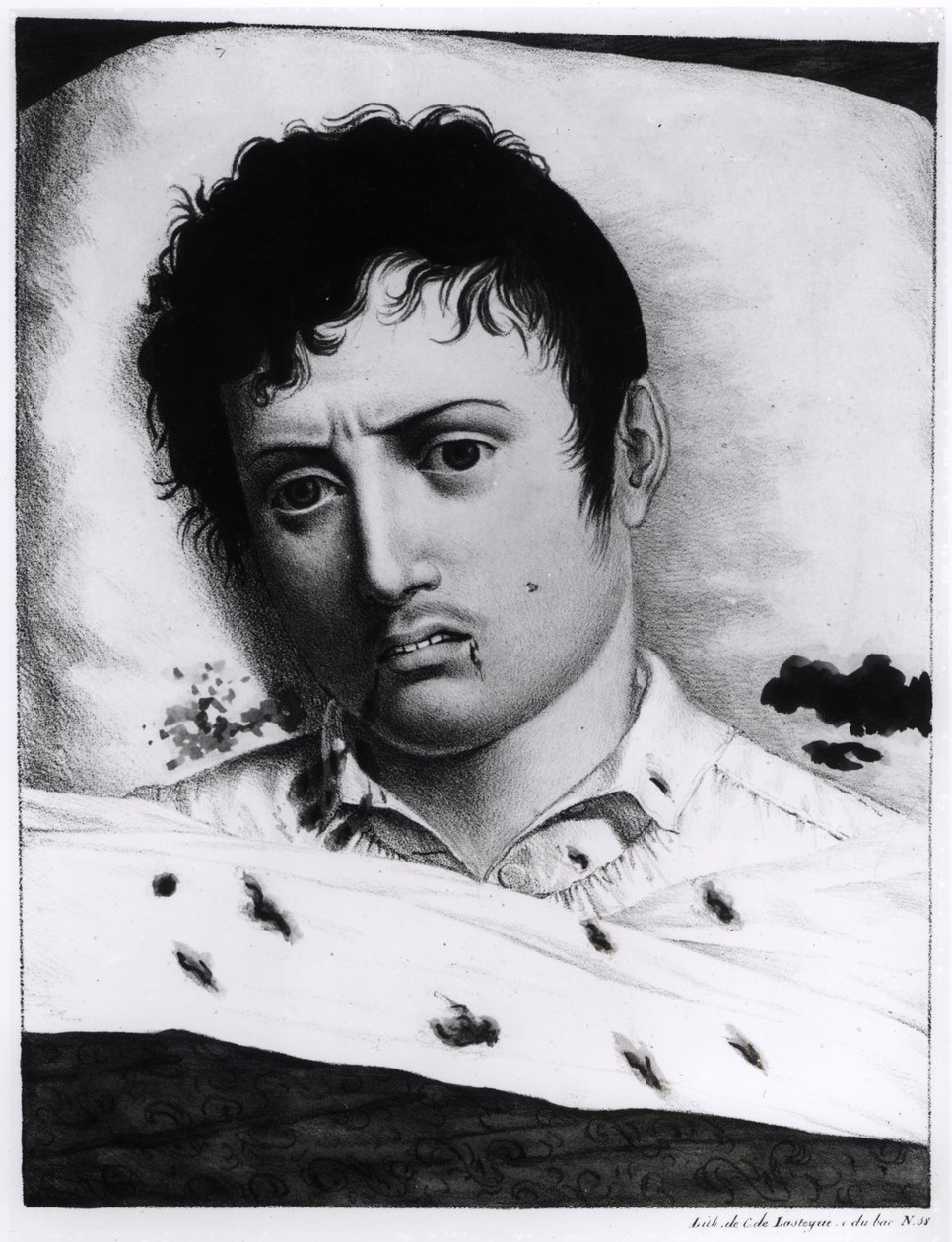 Observasjon av gul feber, ca. 1819 av Charles Lasteyrie du Saillant
