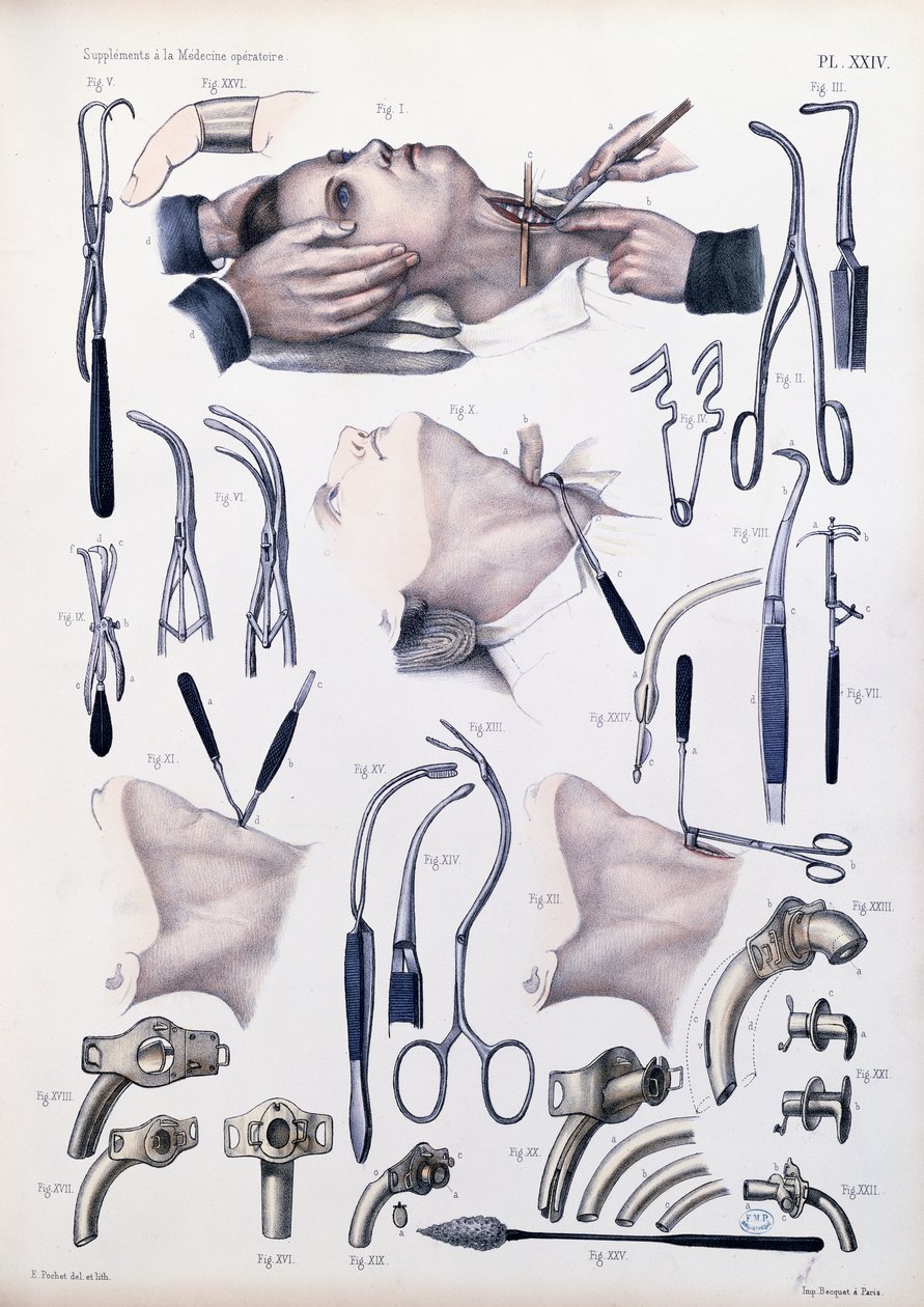 Trakeotomioperasjon, plate fra 