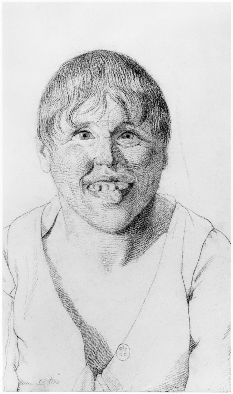 Cretin, sett forfra, illustrasjon fra en upublisert avhandling av Jean Etienne Dominique Esquirol (1772-1840) om galningene på Salpetriere-asylet, ca. 1818 av Georges Francois Gabriel