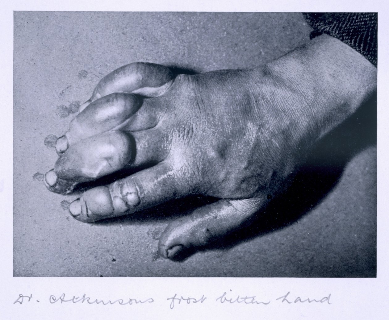 Dr. Atkinsons frostbitte hånd, 1911 av Herbert Ponting