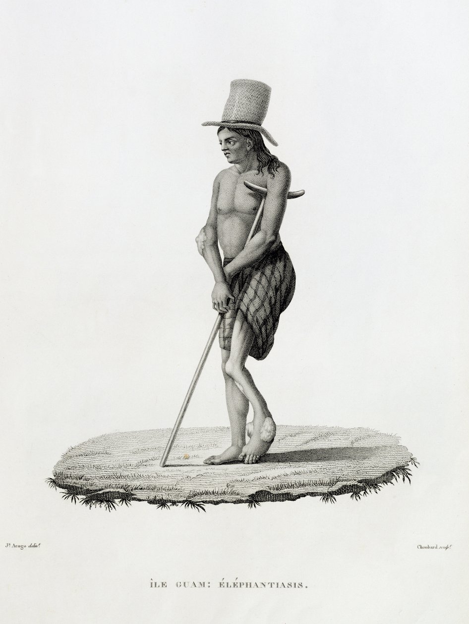 Guam: A Man with Elephantiasis, fra 'Voyage Autour du Monde sur les Corvettes de L'Uranie 1817-20' gravert av Choubard, utgitt 1825 av Jacques Etienne Victor Arago