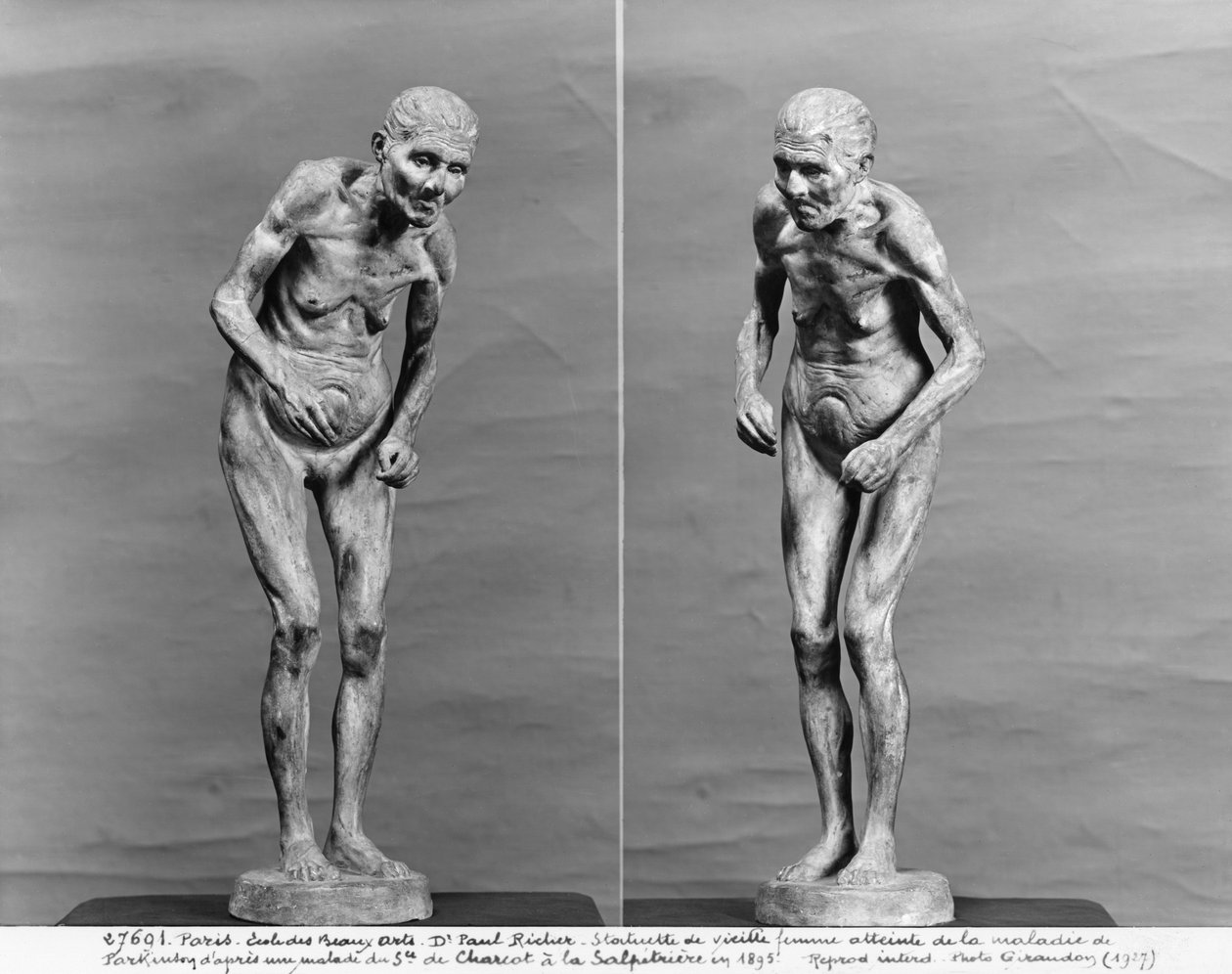Statuett av en gammel kvinne med Parkinsons sykdom, etter 1895 (gips) av Paul Marie Louis Pierre Richer