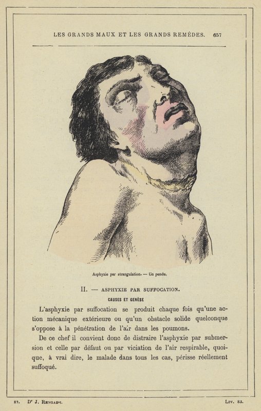 Kvelning ved kvelning, En hengt mann (farge litho) av French School