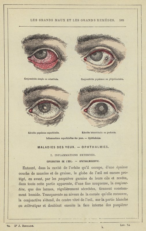 Overfladiske øyebetennelser, oftalmi (fargelitho) av French School