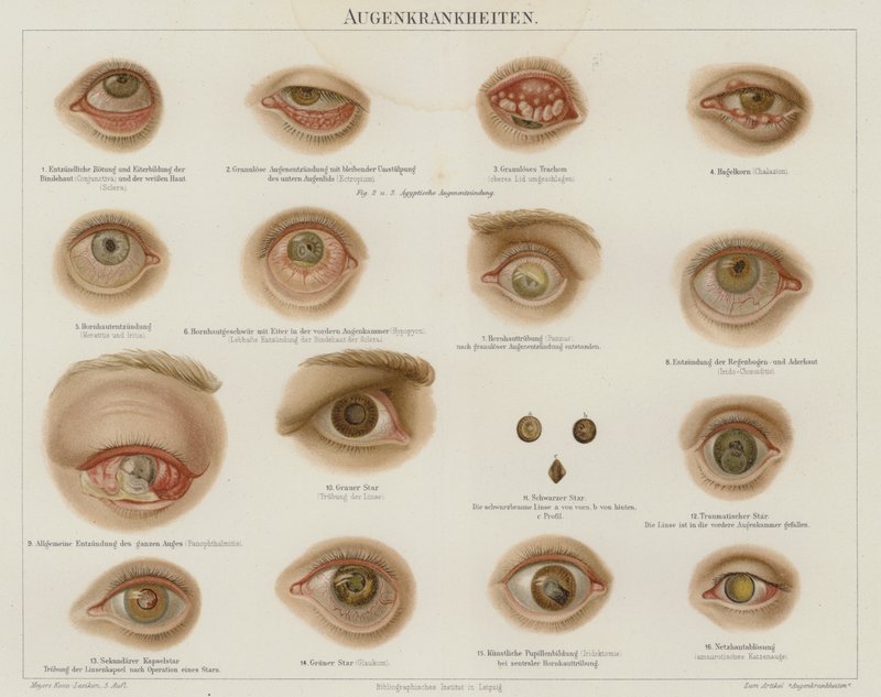 Øyelidelser (farge litho) av German School