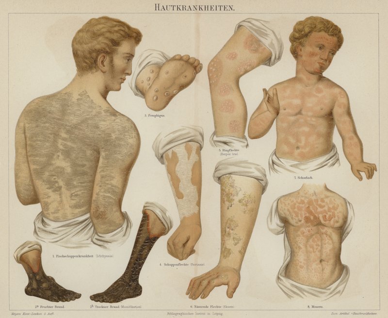 Hudlidelser (farge litho) av German School