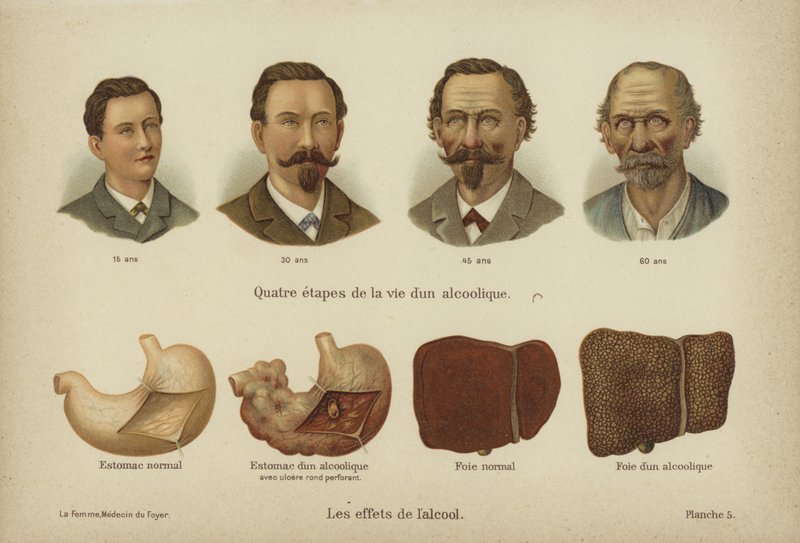 Effektene av alkoholmisbruk (farge litho) av German School